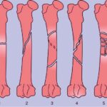 دانلود و خرید کتاب فوریت های شکستگی استخوان